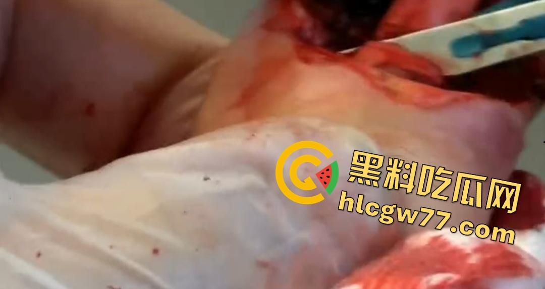 患者天天啃脚指甲狂得甲沟炎！帕尔米耶里手术刀下血肉狂飙，操刀医生差点呕吐！