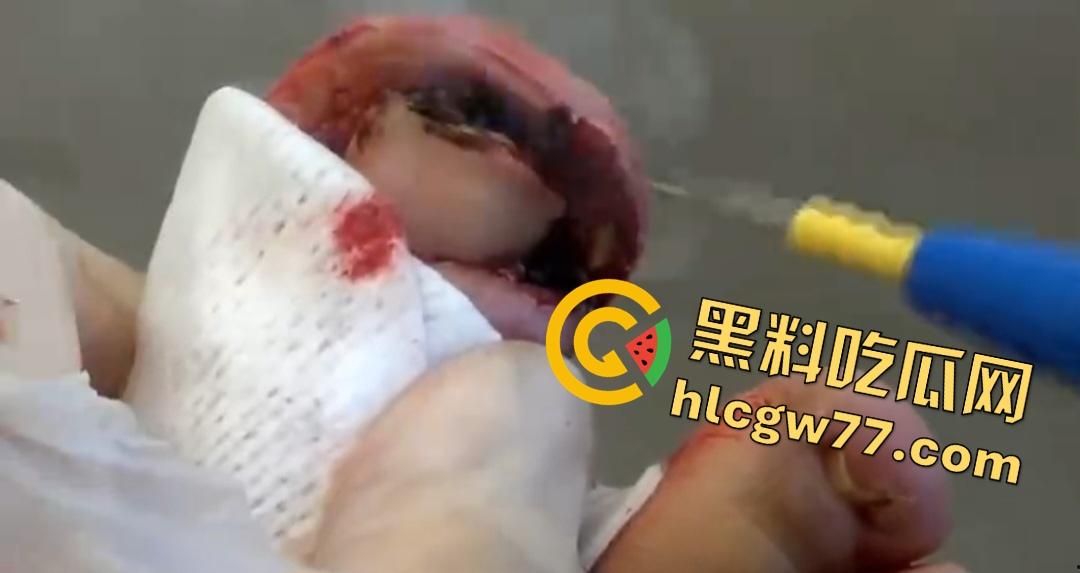 患者天天啃脚指甲狂得甲沟炎!帕尔米耶里手术刀下血肉狂飙,操刀医生差点呕吐!-3