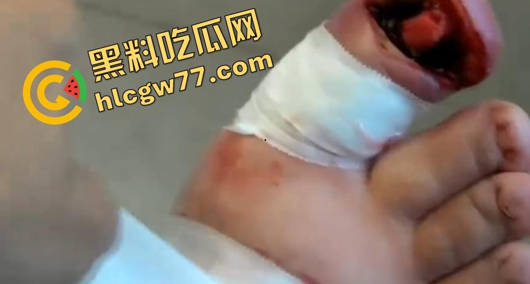 患者天天啃脚指甲狂得甲沟炎!帕尔米耶里手术刀下血肉狂飙,操刀医生差点呕吐!-5