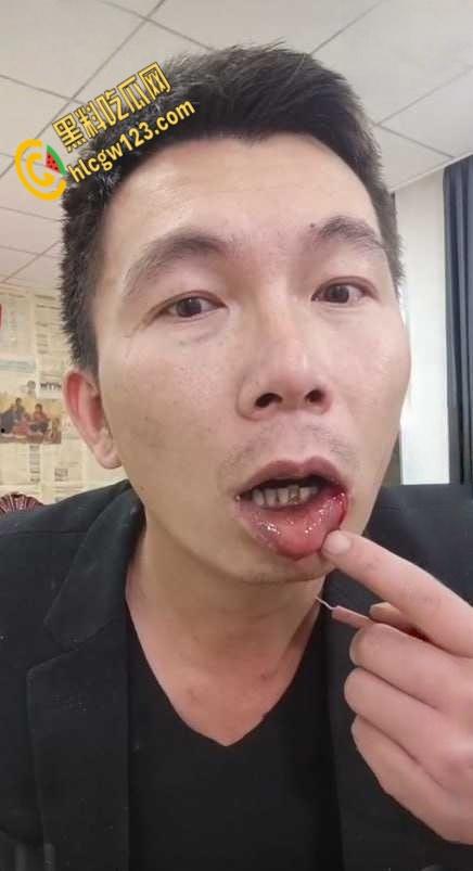 抖音狠人博流量 , 鞭炮嘴炸出血，脑残操作震惊全网 ！-8